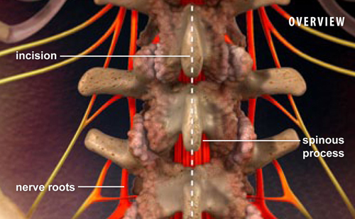 What is a Laminectomy?