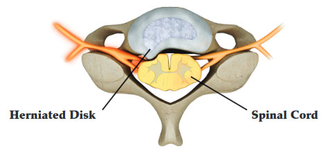 What is Microdiscectomy for herniated disc?