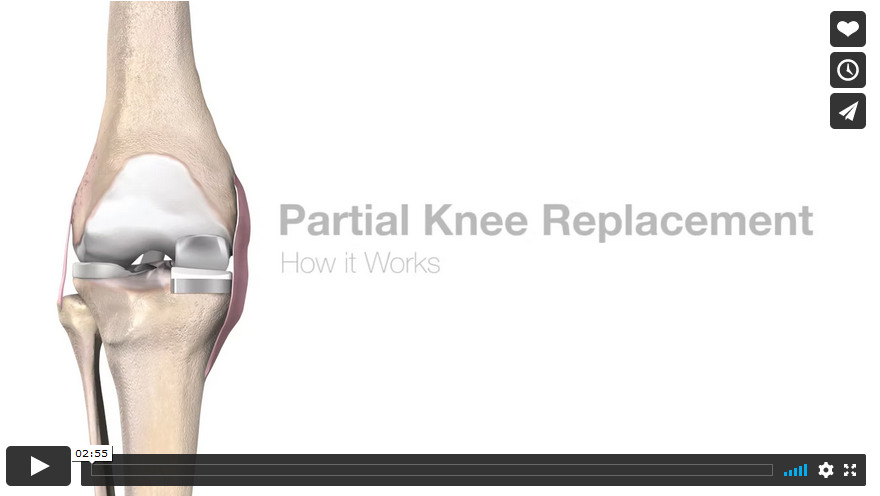 Mako Partial Knee Replacement Video