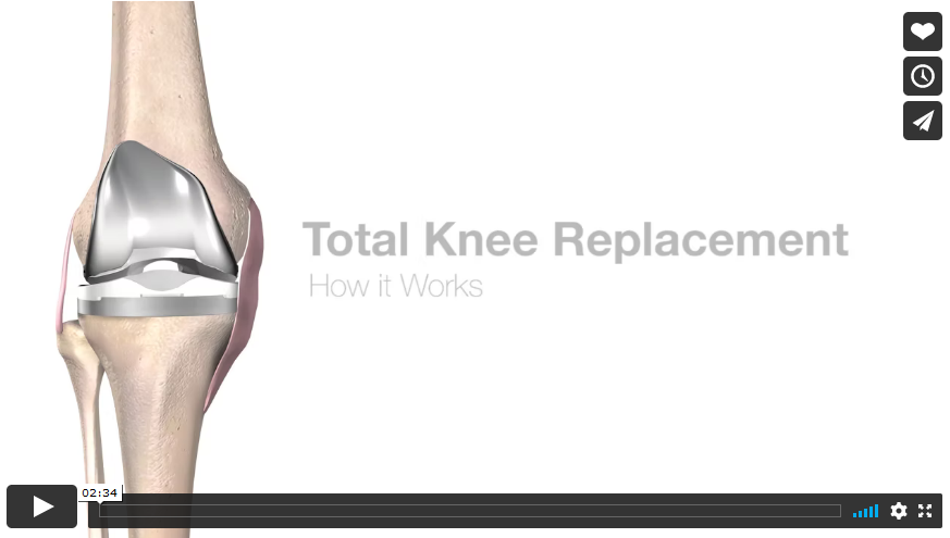 mako-total-knee-replacement-video